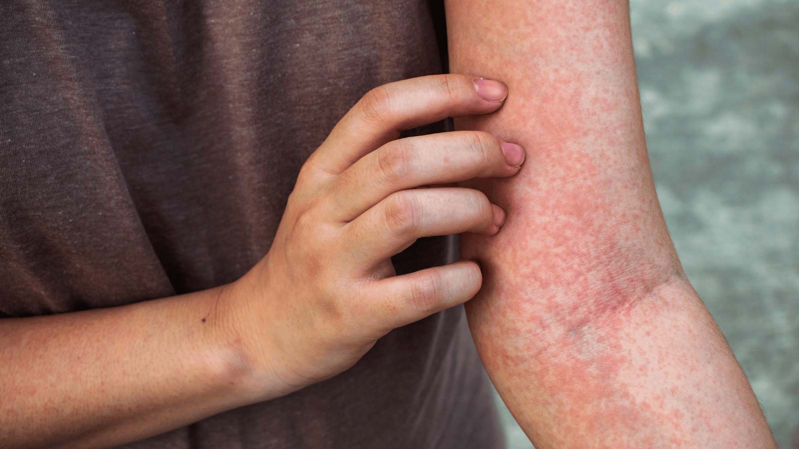 pokeweed rash picture